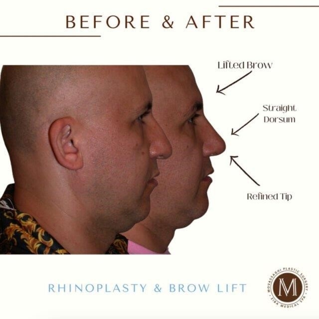 rhinoplasty expert nyc